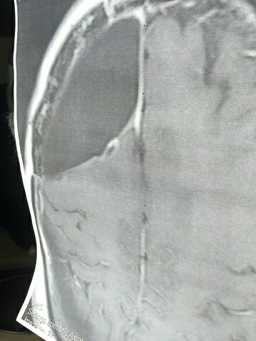 Medical scan dated March 16 after combined cannabinoid approach